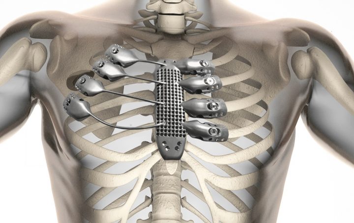 World’s First 3D Printed Polymer Rib Cage Reconstruction​